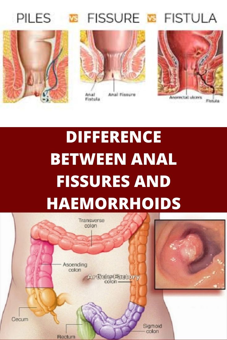 Difference Between Anal Fissures And Haemorrhoids Yoga4daily 6772