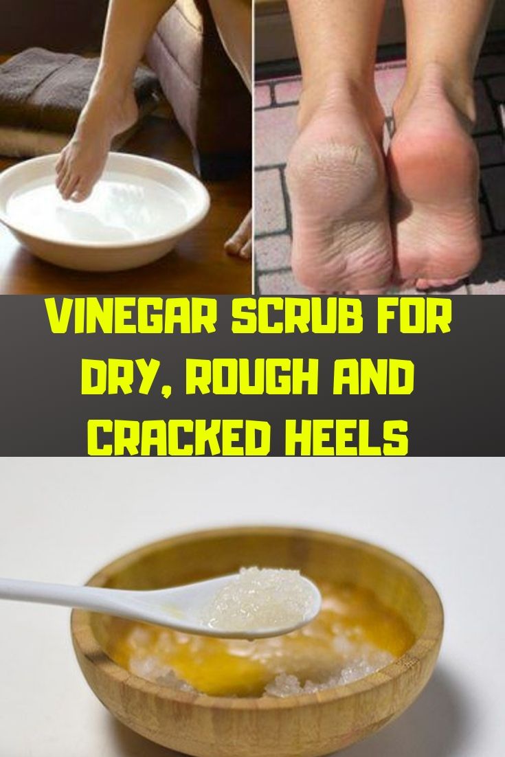 VINEGAR SCRUB FOR DRY, ROUGH AND CRACKED HEELS