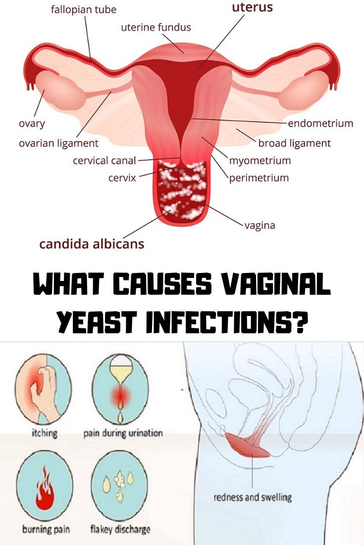 WHAT CAUSES VAGINAL YEAST INFECTIONS? – Yoga4daily