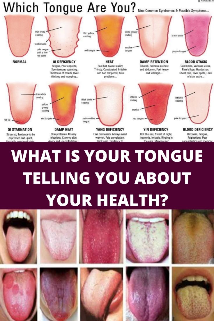 WHAT IS YOUR TONGUE TELLING YOU ABOUT YOUR HEALTH?
